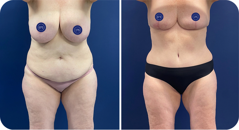 Before and after body contouring results showing front torso view with measurement markers