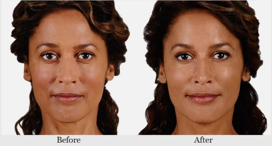 Before-and-after frontal facial photos showing reduced facial lines and improved skin appearance
