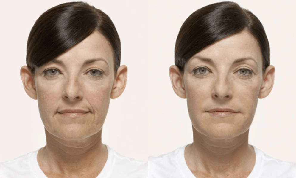 Before-and-after frontal facial photos showing subtle skin texture and volume improvement with Radiesse treatment