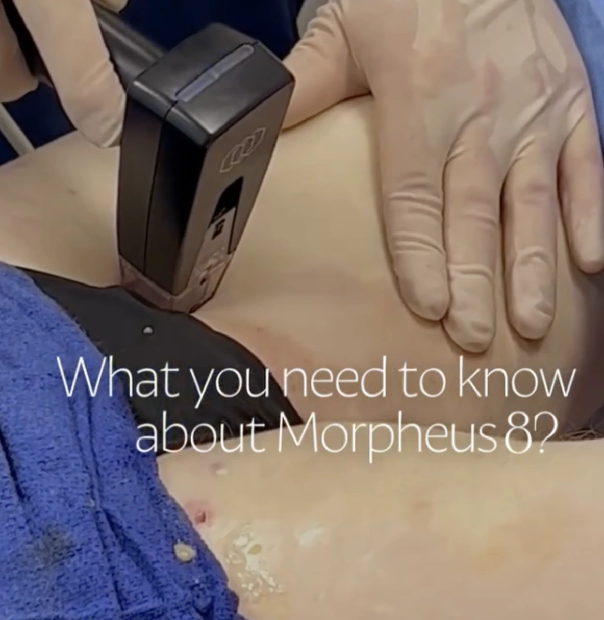 Provider using Morpheus8 device on patient's arm during treatment