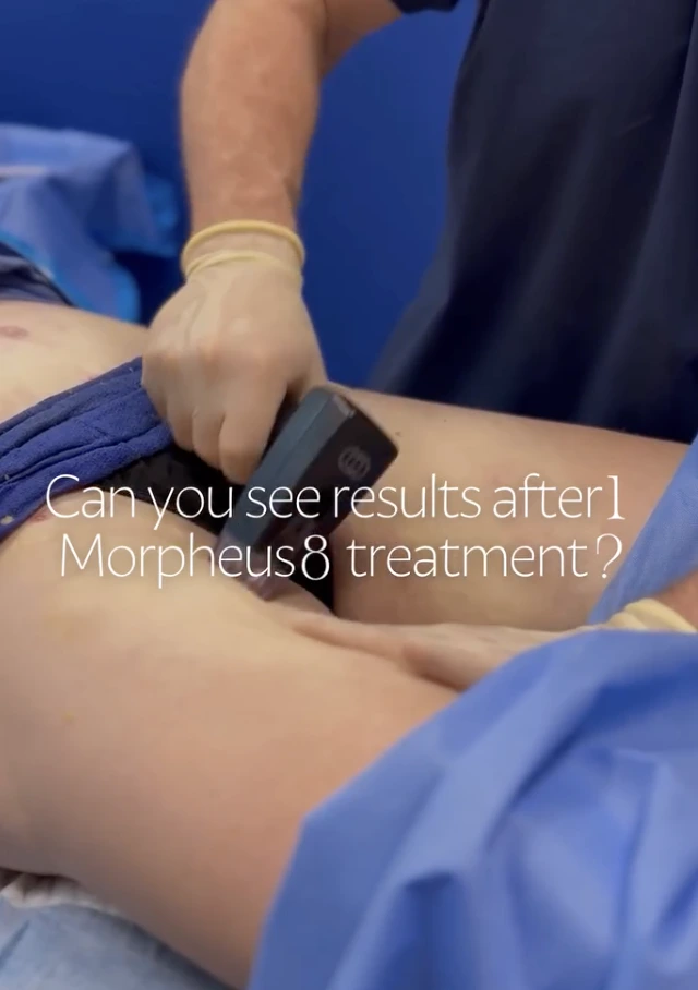 Provider applying Morpheus8 device to patient's arm during procedure