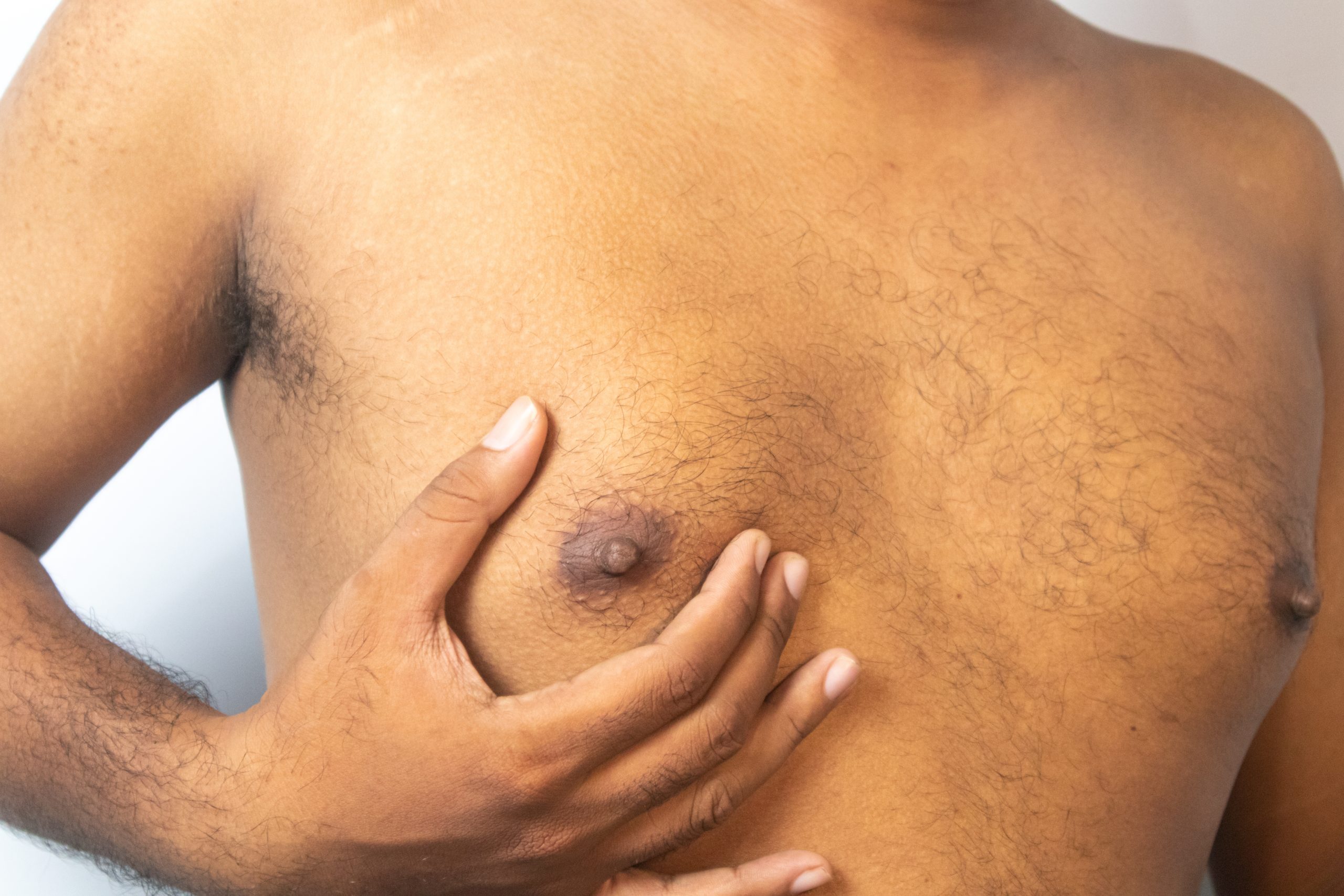 What Causes Gynecomastia and How Is It Treated? Banner