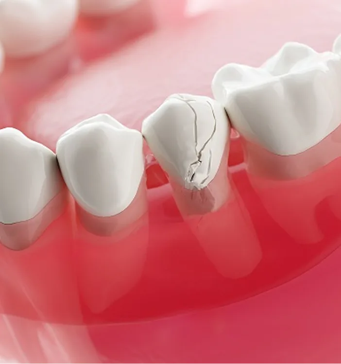 Dental model showing a broken tooth with a crack running through the center tooth between two intact teeth