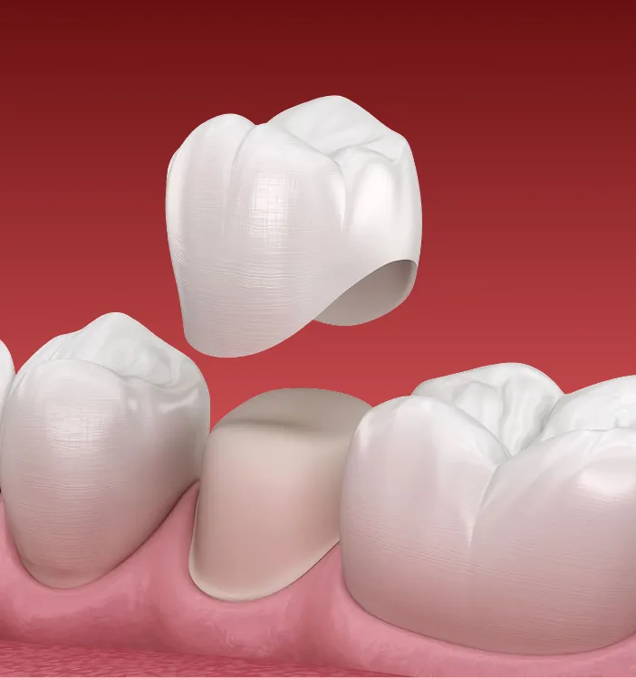 3D illustration of white dental crowns positioned over a tooth model on pink gum tissue