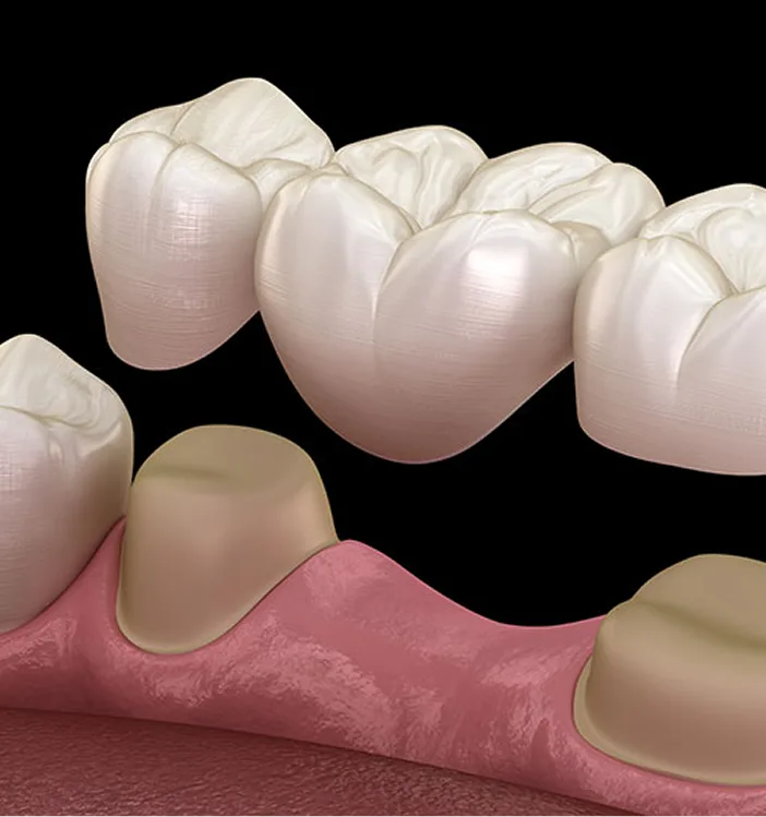 Dental crown restoration showing missing tooth gap with ceramic crowns positioned above gumline