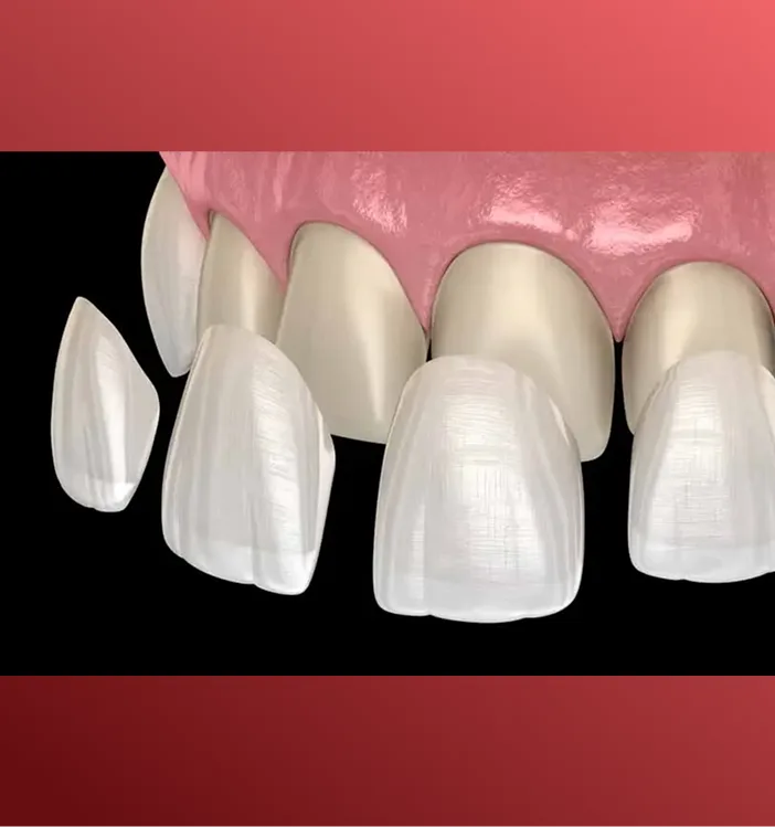 Porcelain veneers displayed separately and applied to front teeth model showing white, natural appearance