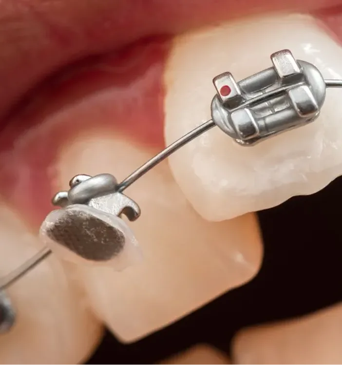 Orthodontic bracket and wire positioned on a tooth during treatment