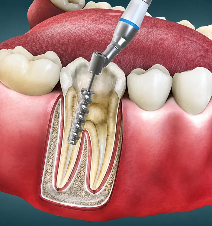 Dental instrument performing root canal treatment on a tooth's interior canal system