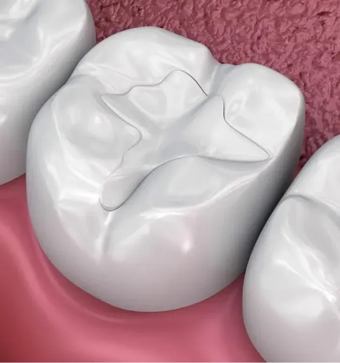 Tooth-colored filling restoration on molar showing natural appearance blended with tooth surface