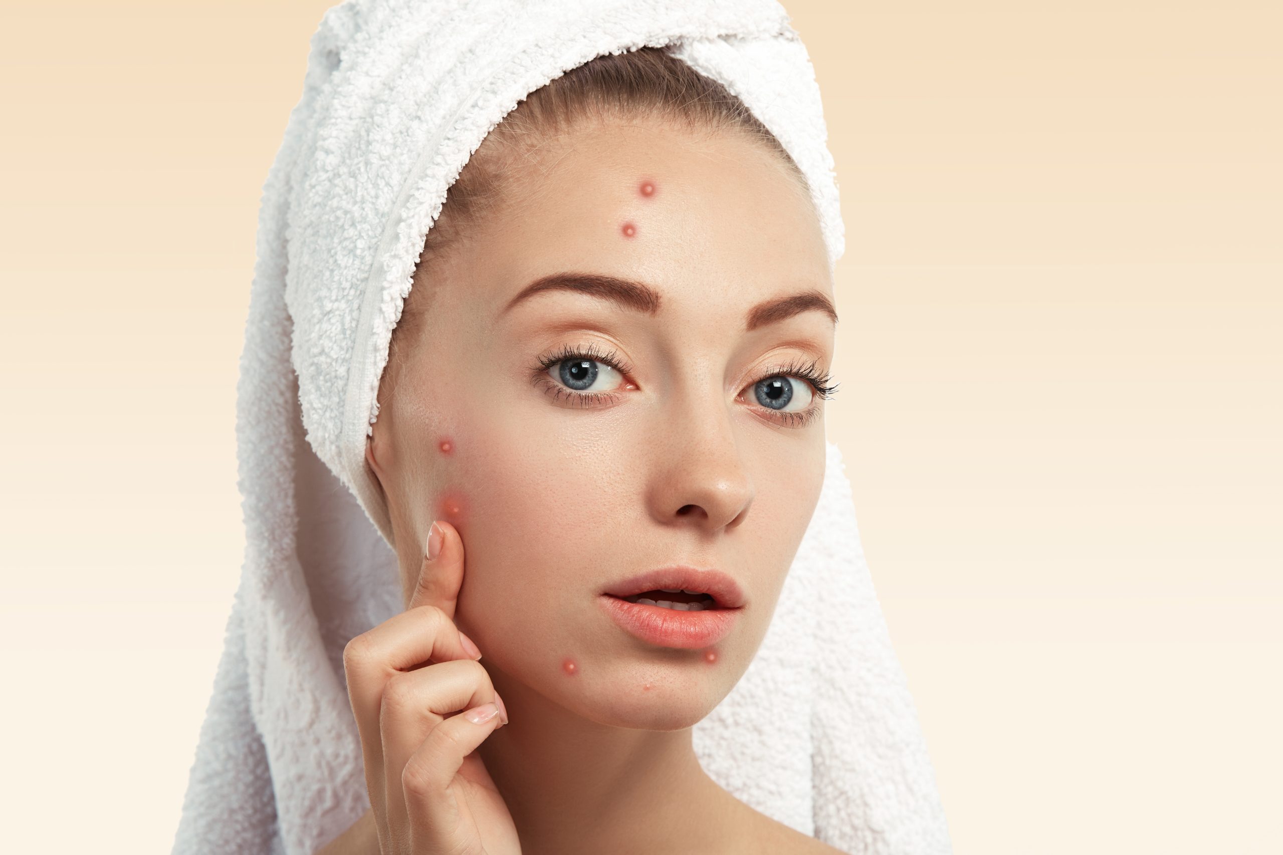 Can Fotona Laser Remove Deep Acne Scars? Banner