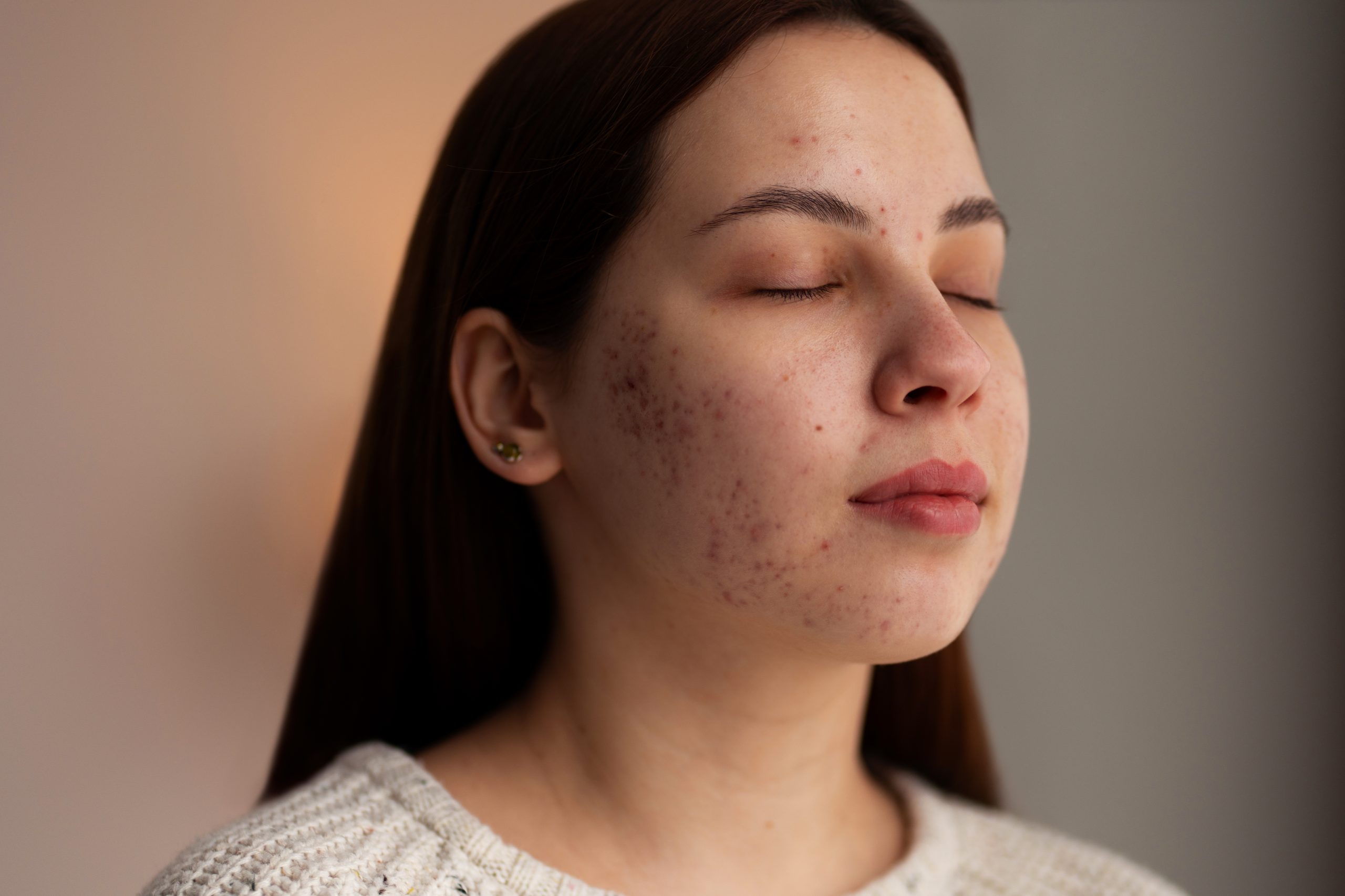 Is Fotona Better Than CO2 Laser for Acne Scars? Banner
