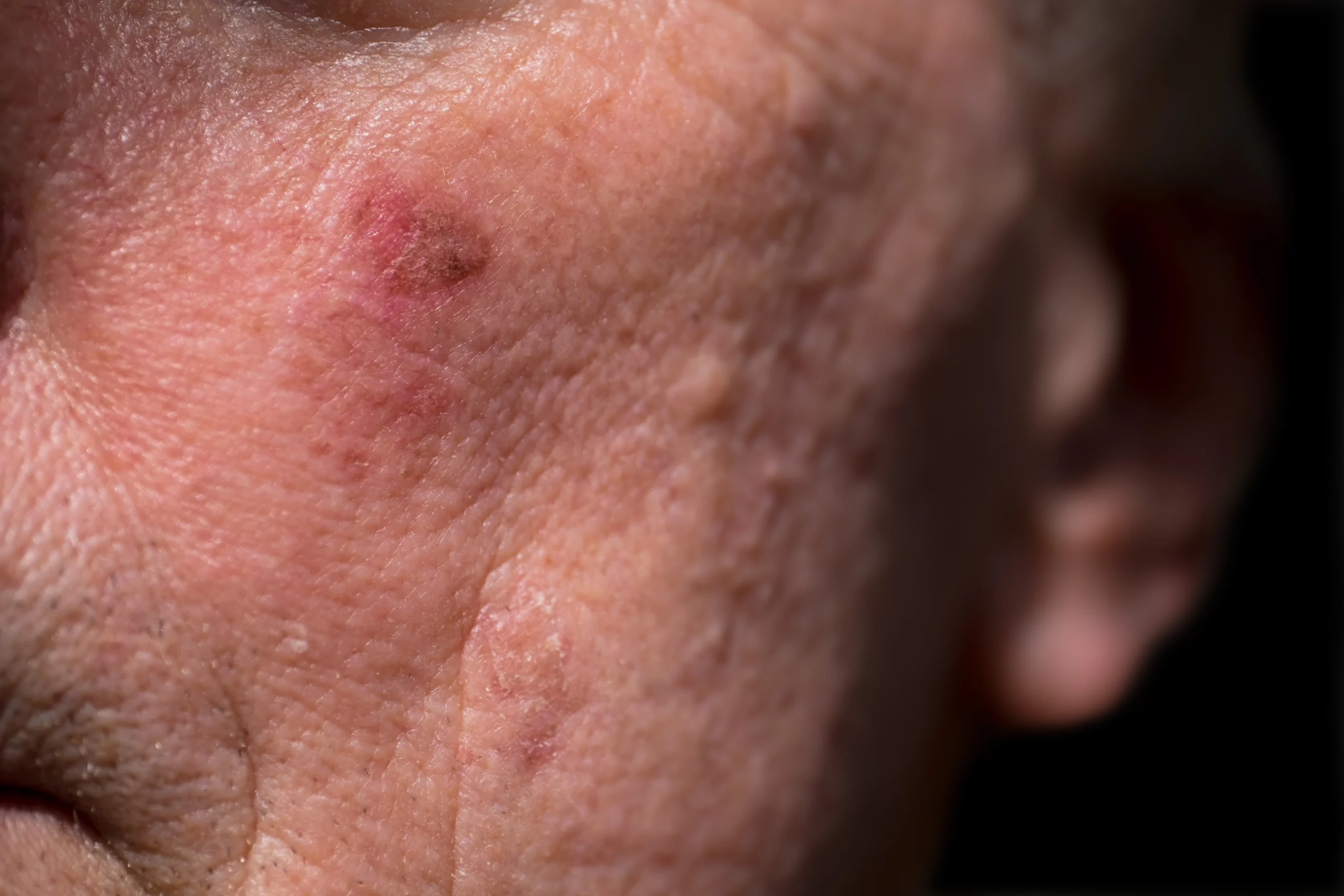 Close-up of actinic keratosis on sun-damaged skin showing a rough, scaly lesion