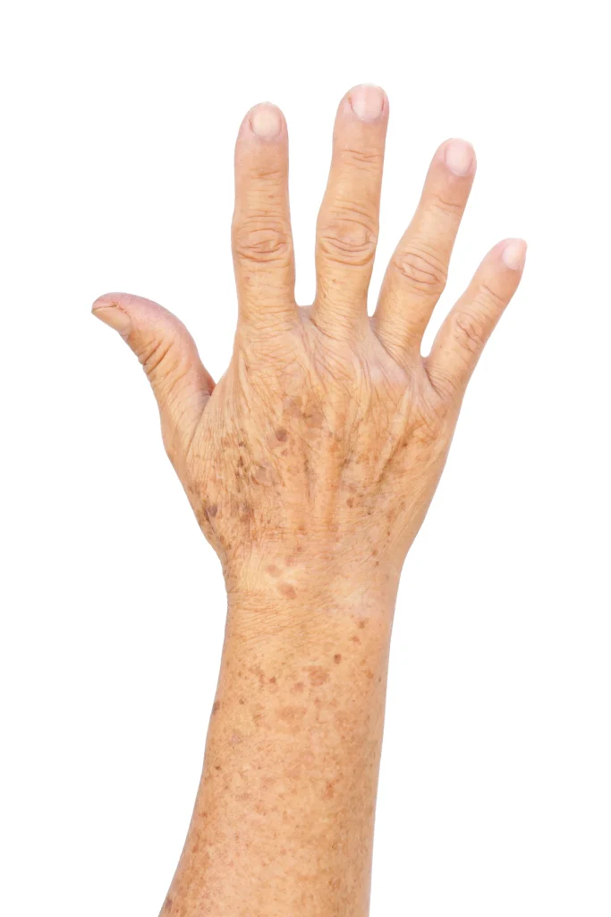 Hand with multiple age spots and sun damage across the palm and fingers