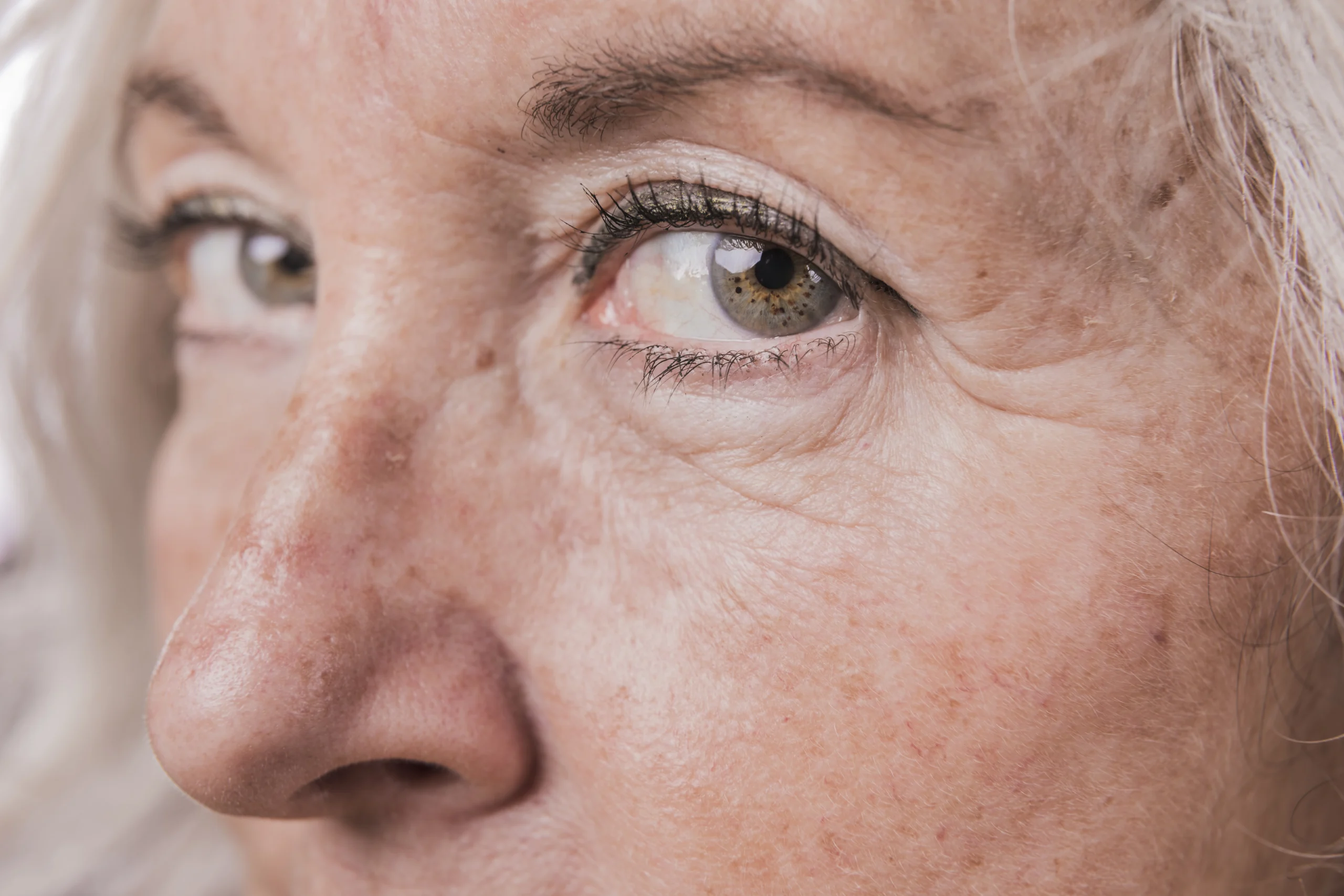 Close-up of an older adult's face showing age spots and sun damage on the cheek and around the eye area