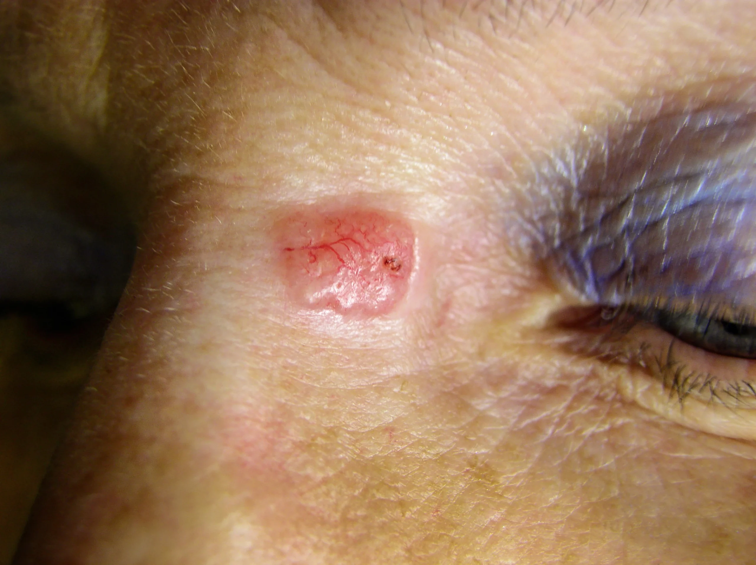 Close-up of basal cell carcinoma lesion on skin near the eye
