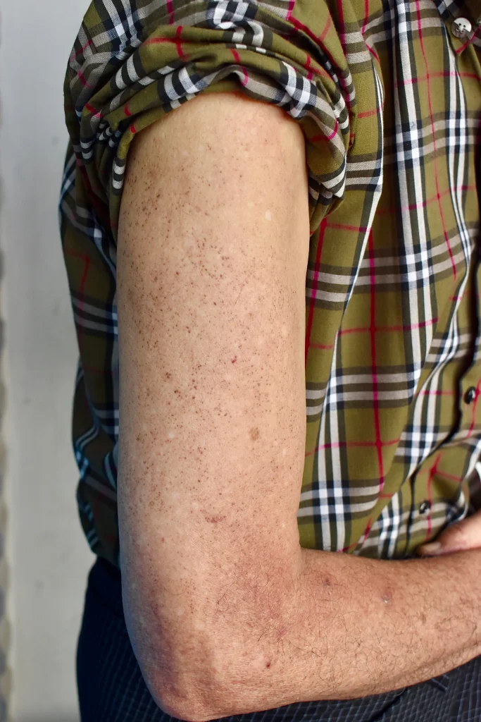 Patient's arm showing basal cell carcinoma lesions and sun damage