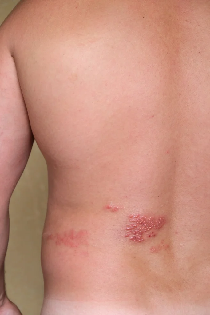 Herpes simplex lesions with grouped vesicles on skin