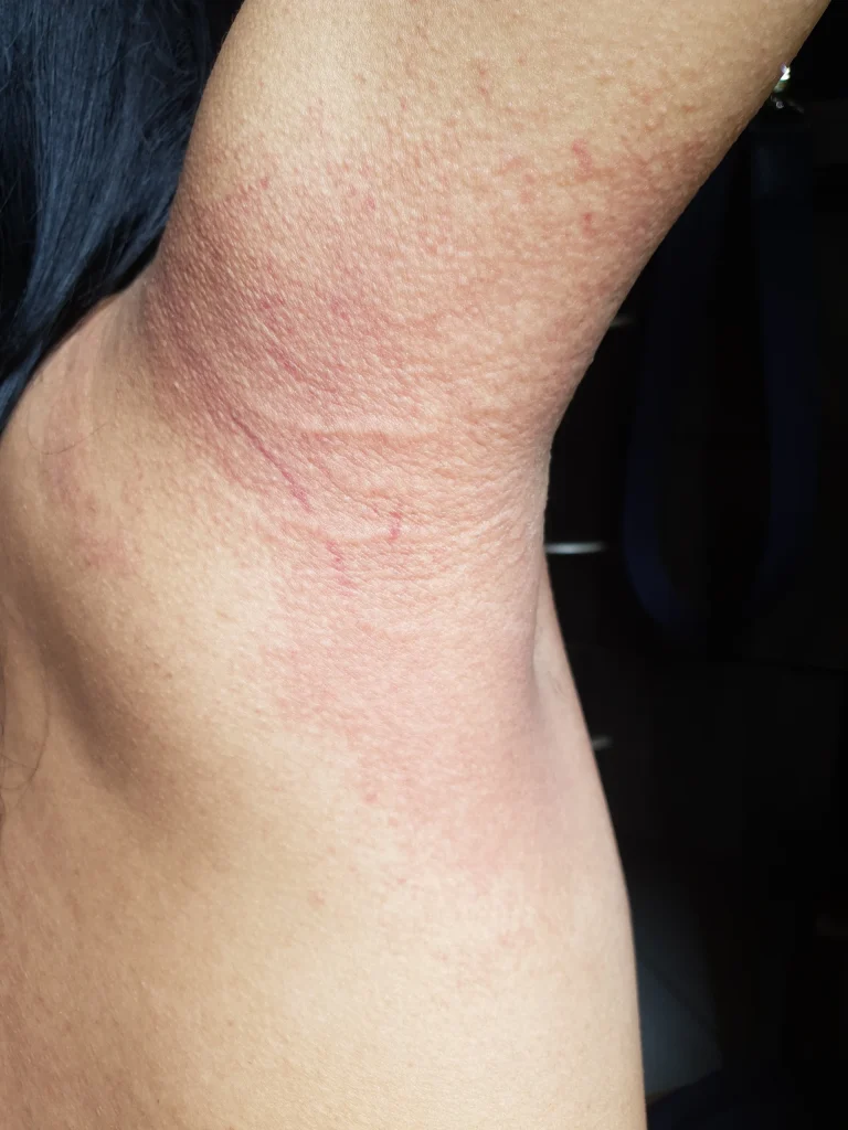 Red, inflamed rash in skin fold area showing intertrigo condition