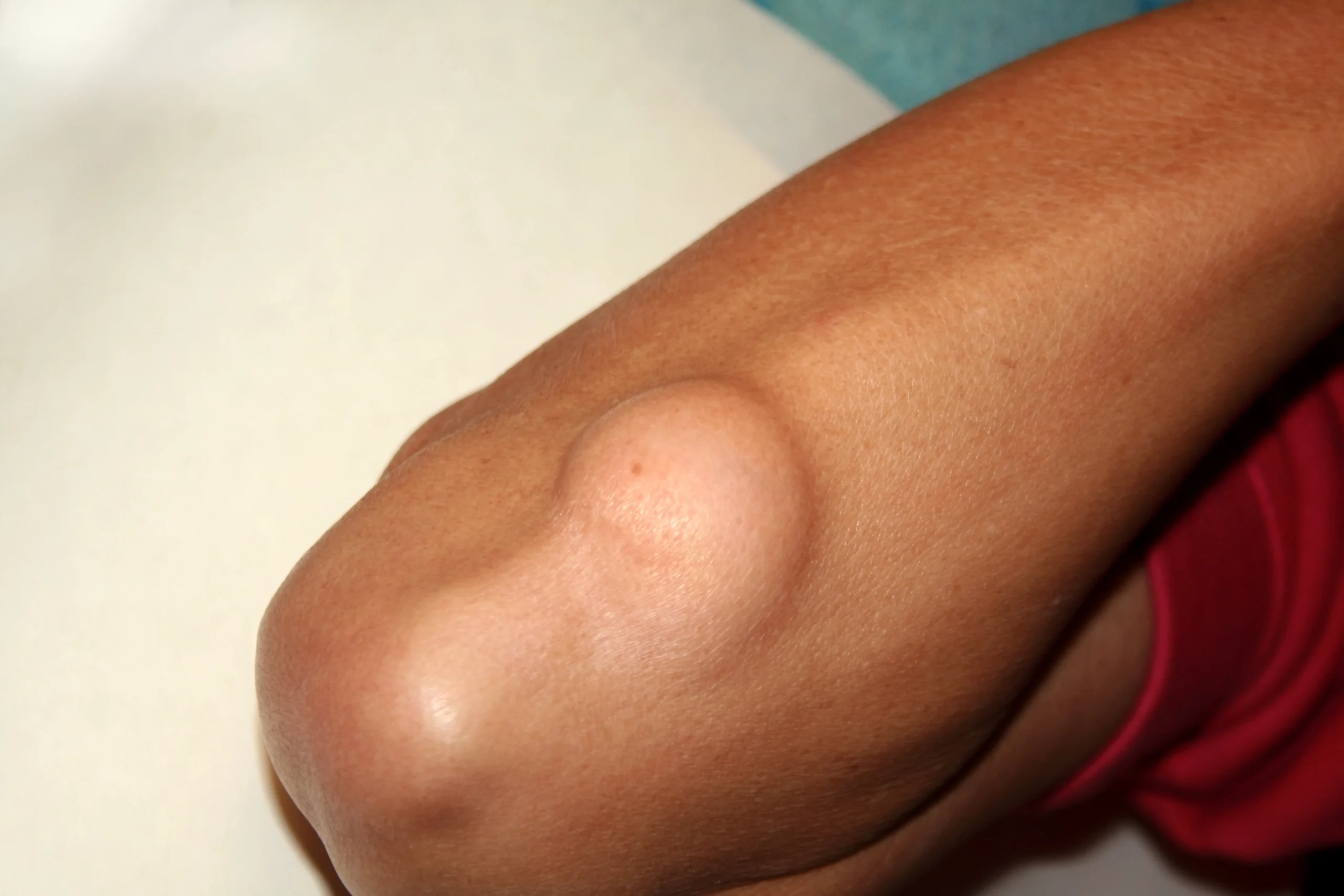 Lipoma on a patient's arm, showing a round, raised fatty growth beneath the skin