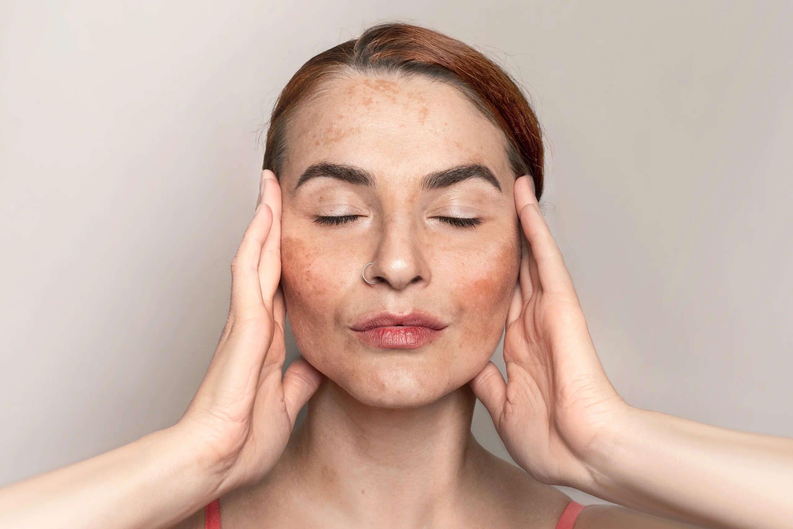 Woman with melasma displaying brown patches across forehead and cheeks