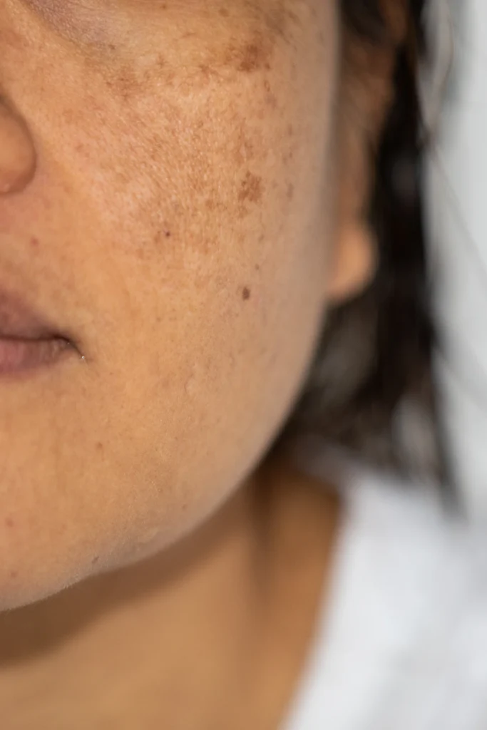 Close-up of a patient's cheek showing melasma with brown patches on the skin