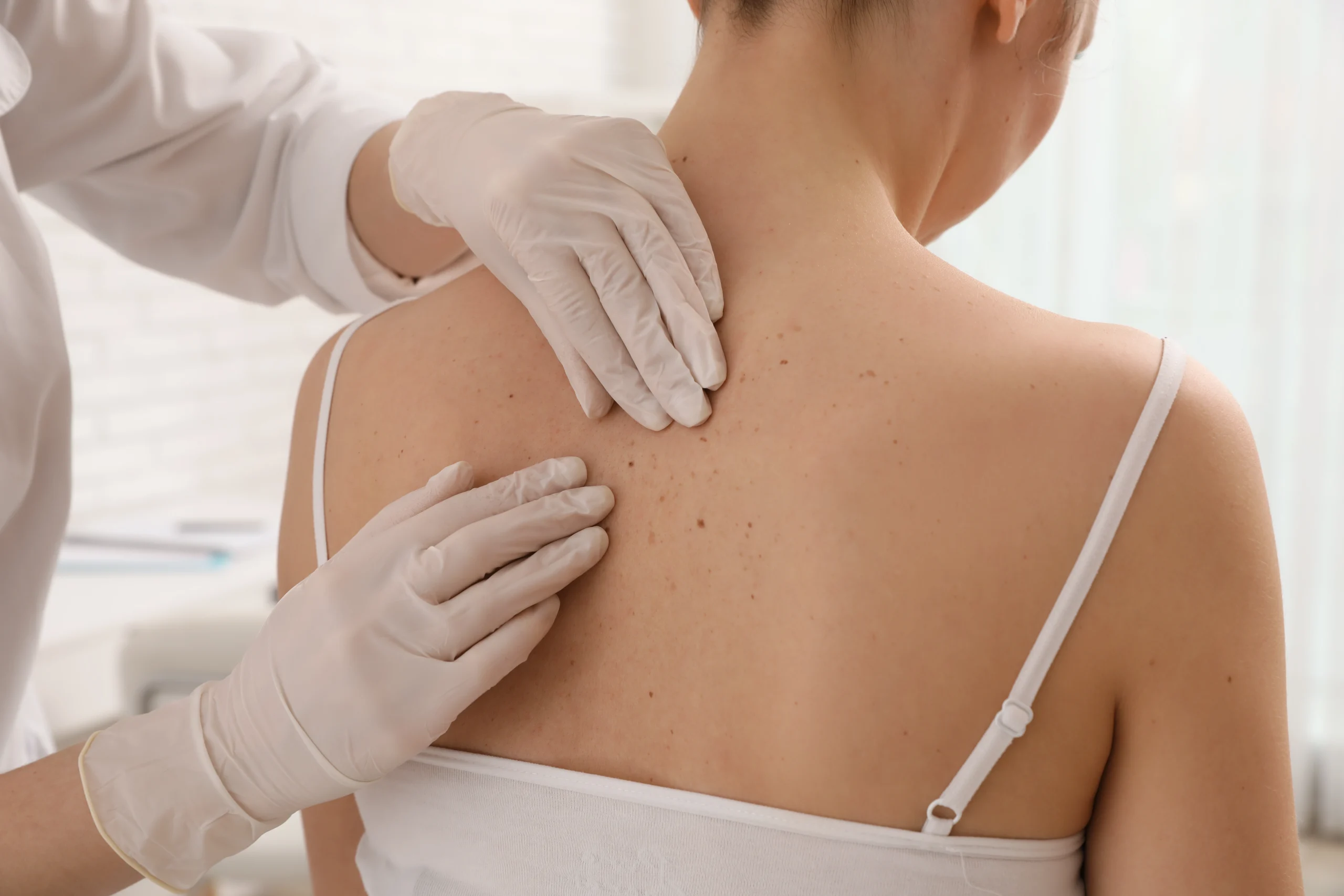 Dermatologist examining a patient's back and shoulders for skin lesions during a Mohs procedure consultation