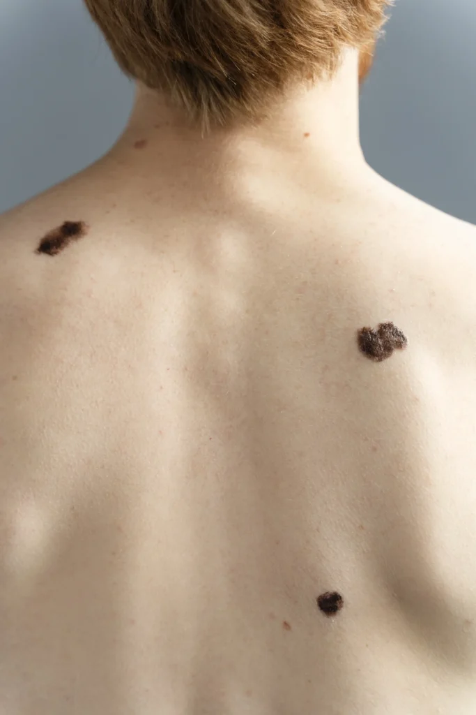Back view of a person showing multiple moles of varying sizes on the skin