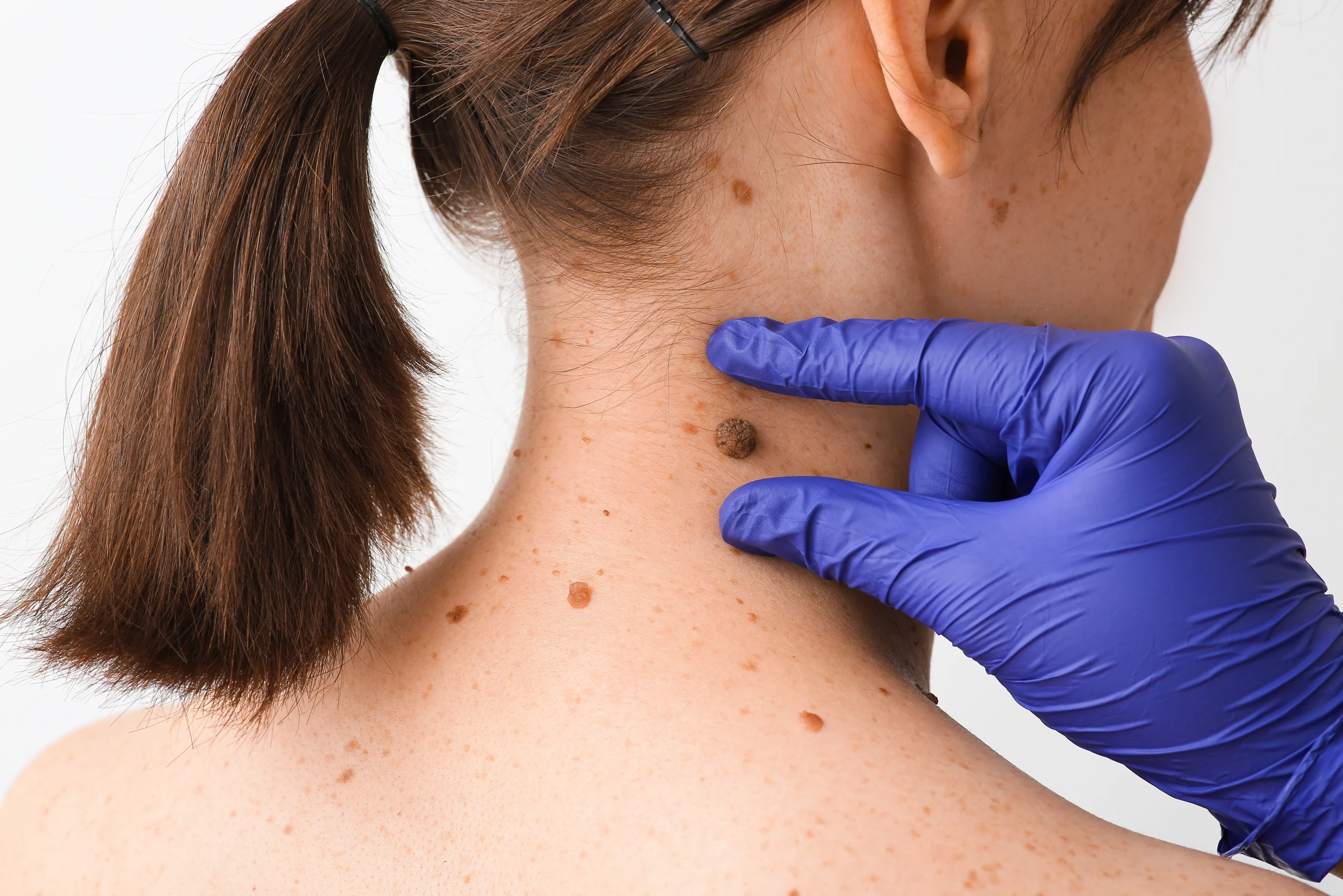 Dermatologist in blue gloves examining a mole on a patient's neck and shoulder