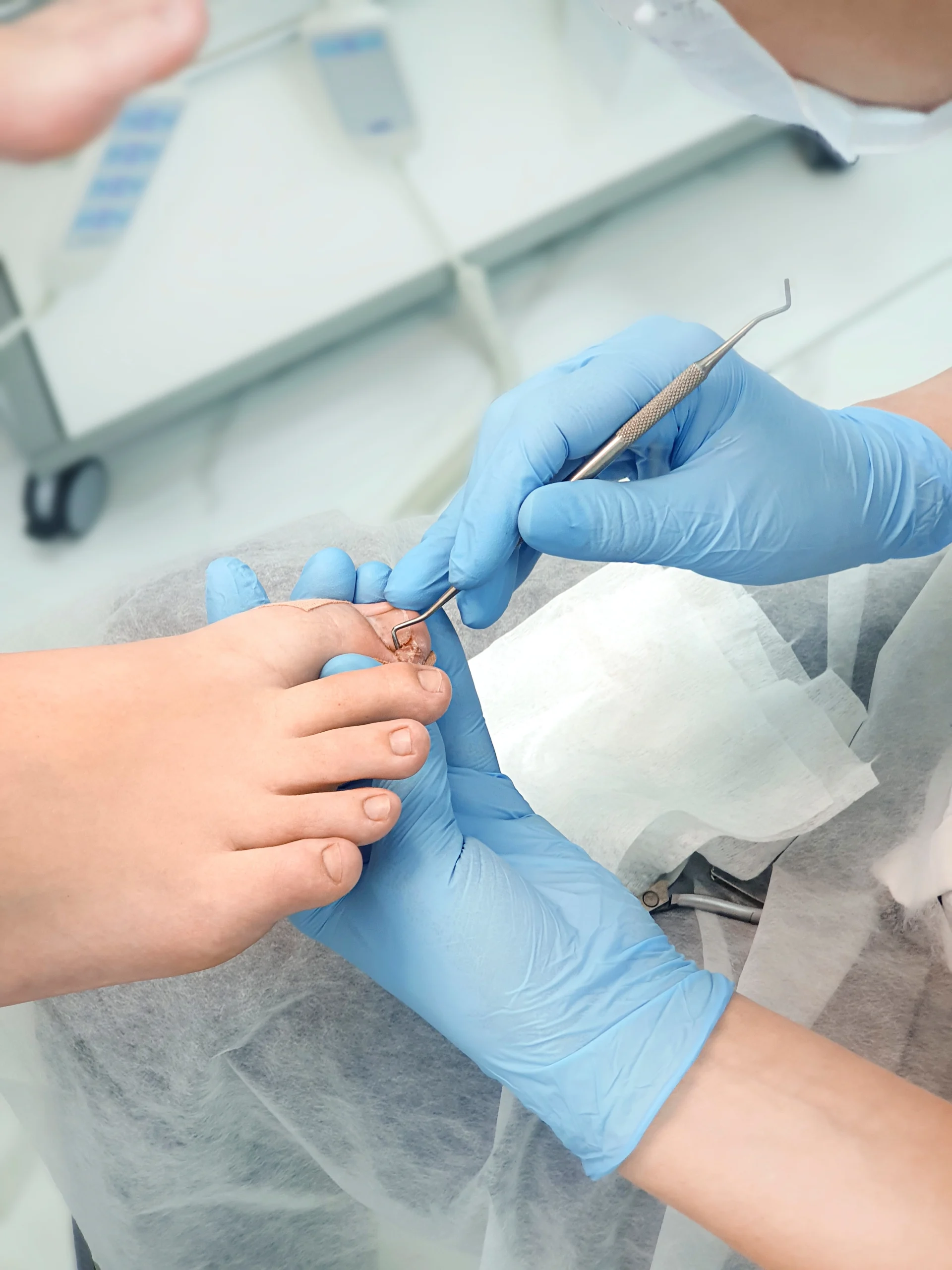 Gloved provider performing nail surgery with specialized instrument on patient's toe