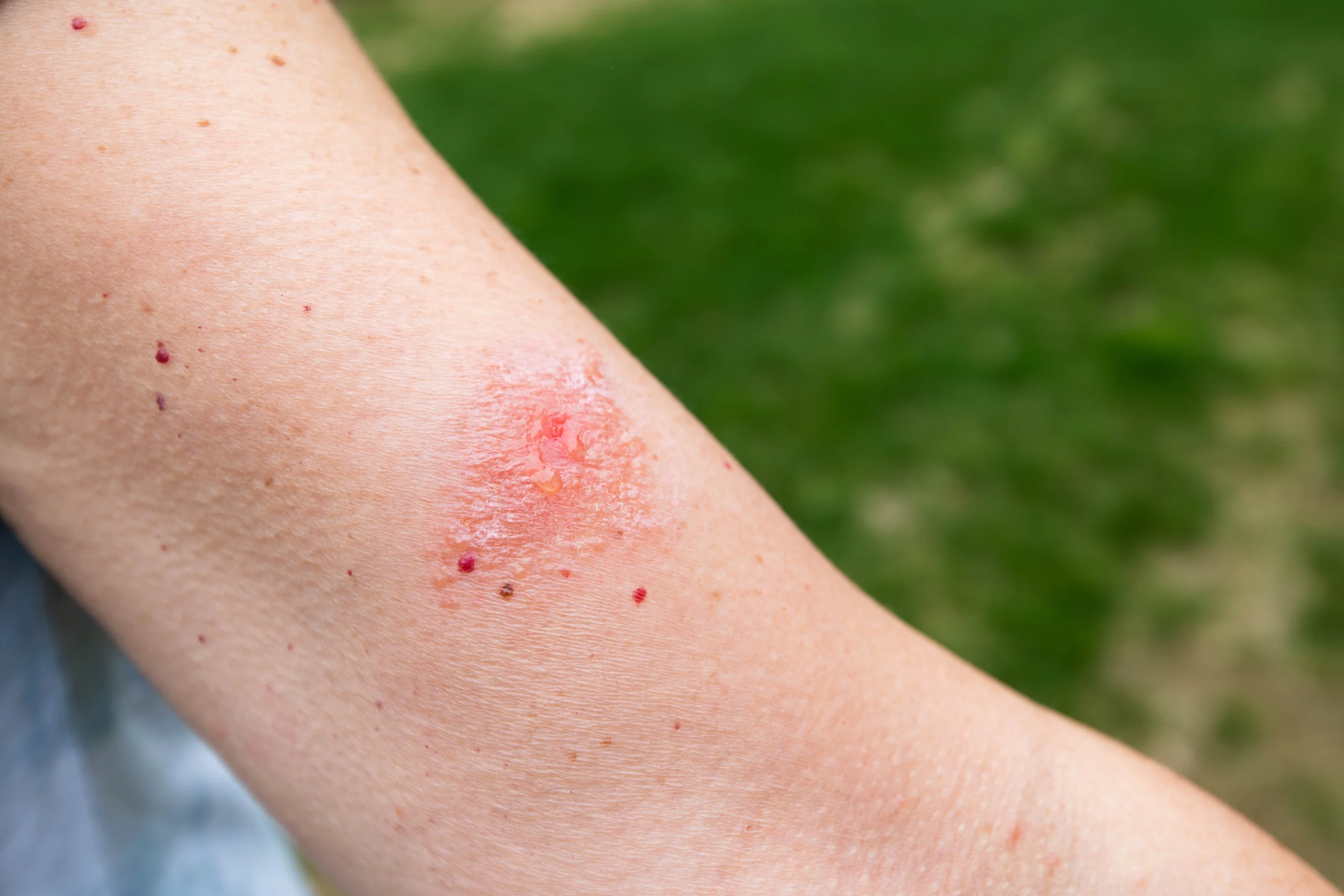Close-up of poison ivy rash on forearm showing red, inflamed patches and small blisters