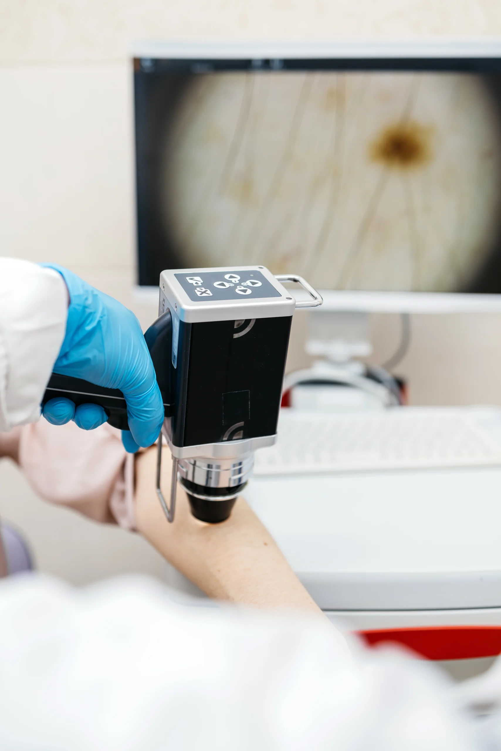 Provider in blue gloves holding a dermatoscope with magnified skin lesion displayed on monitor behind
