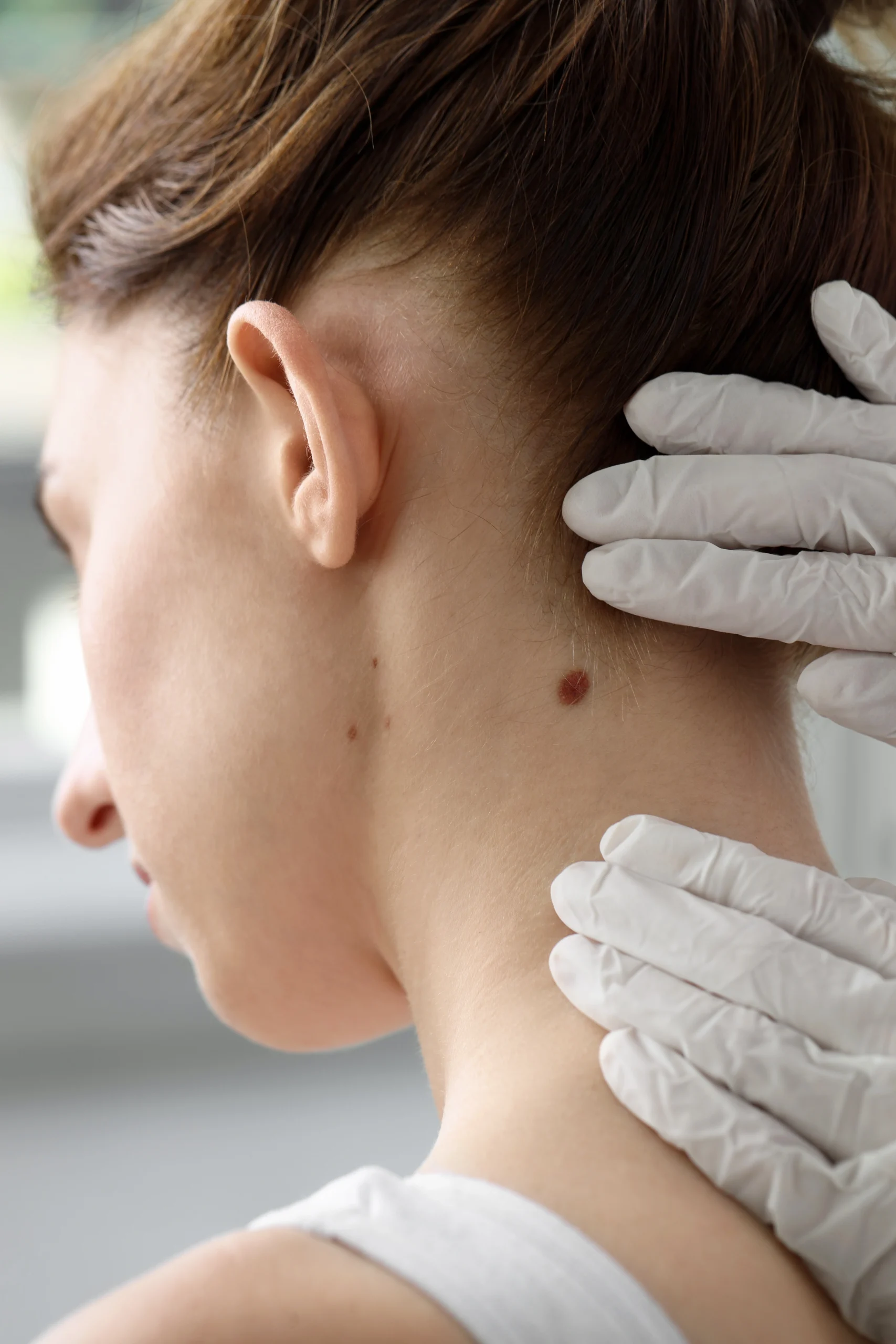Dermatologist in gloved hands examining a patient's neck and moles from behind
