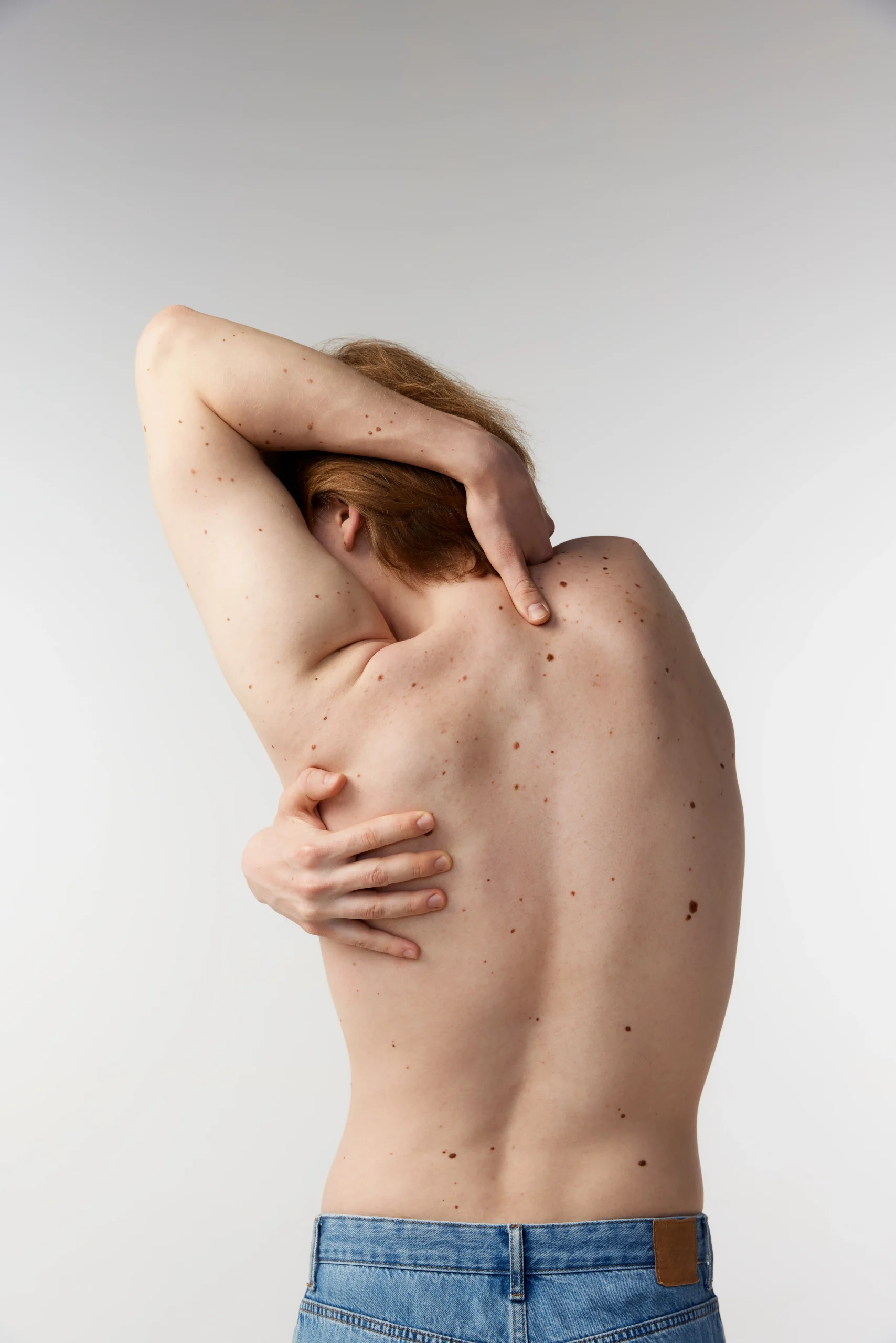 Person from behind displaying multiple moles and skin lesions across back and shoulders for skin cancer screening