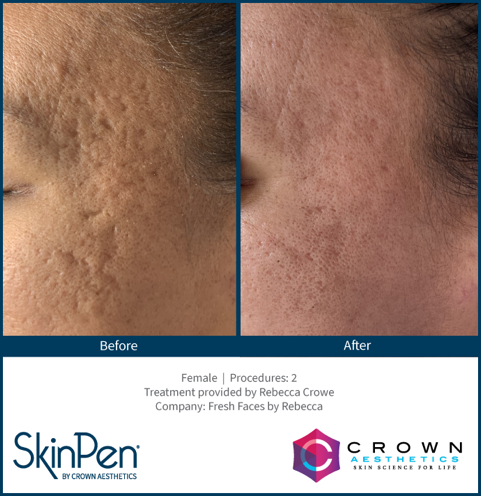 SkinPen-Before_and_After-1