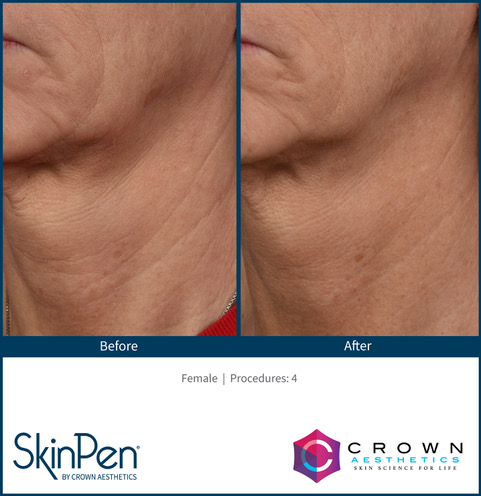 SkinPen-Before_and_After-2