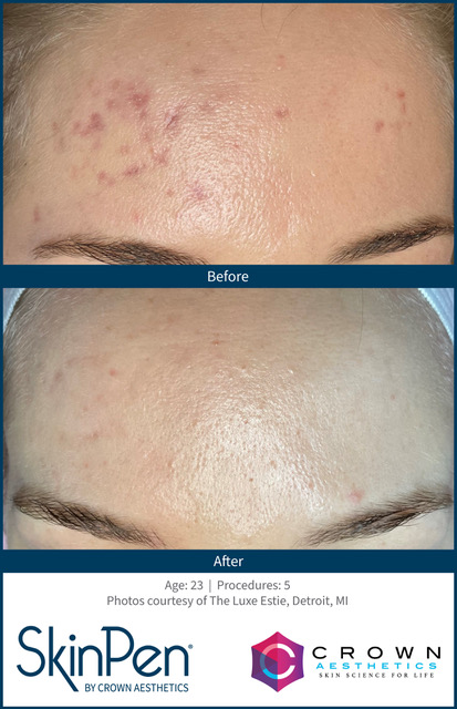 SkinPen-Before_and_After-3