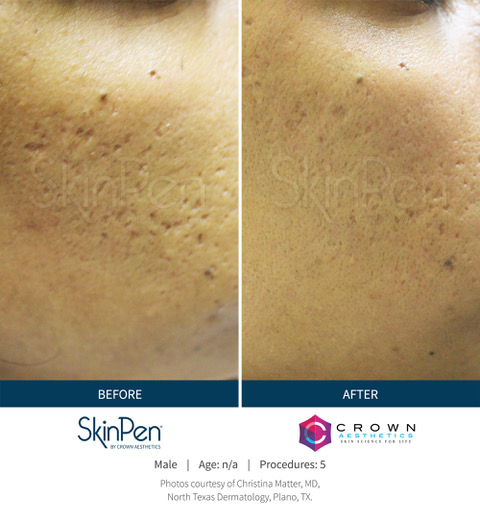 SkinPen-Before_and_After-4