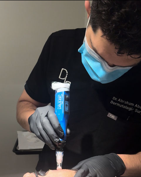 SkinPen-Procedure
