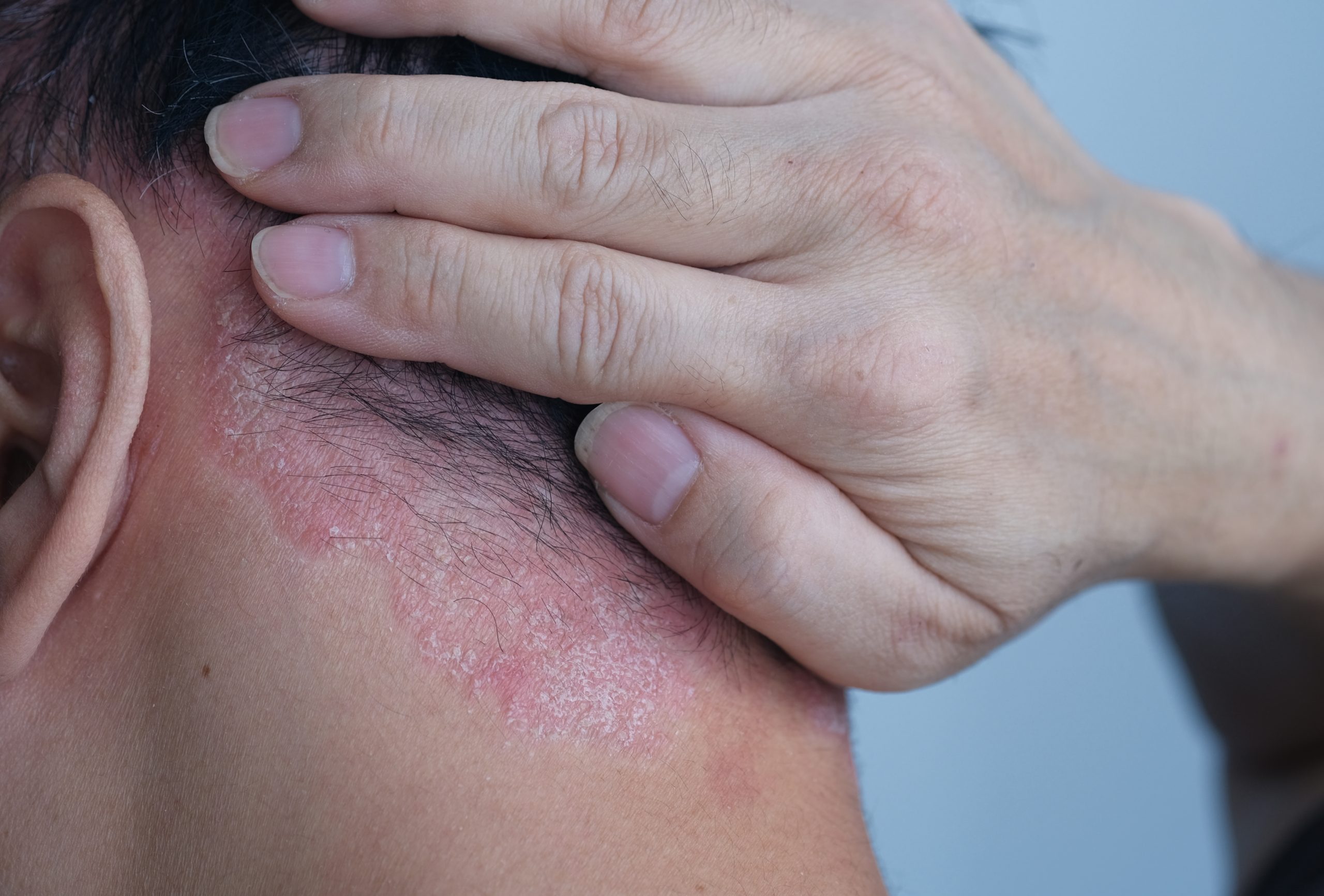 Close-up of psoriasis patches on a man's nape and neck area