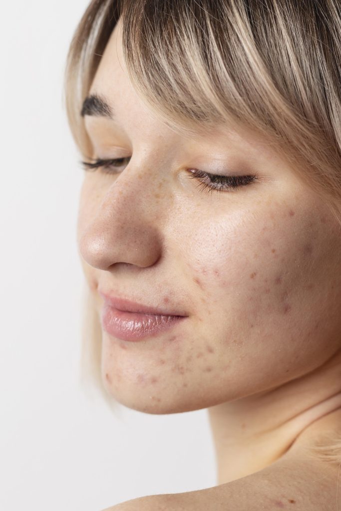 Woman's profile showing acne breakouts on cheeks and jawline