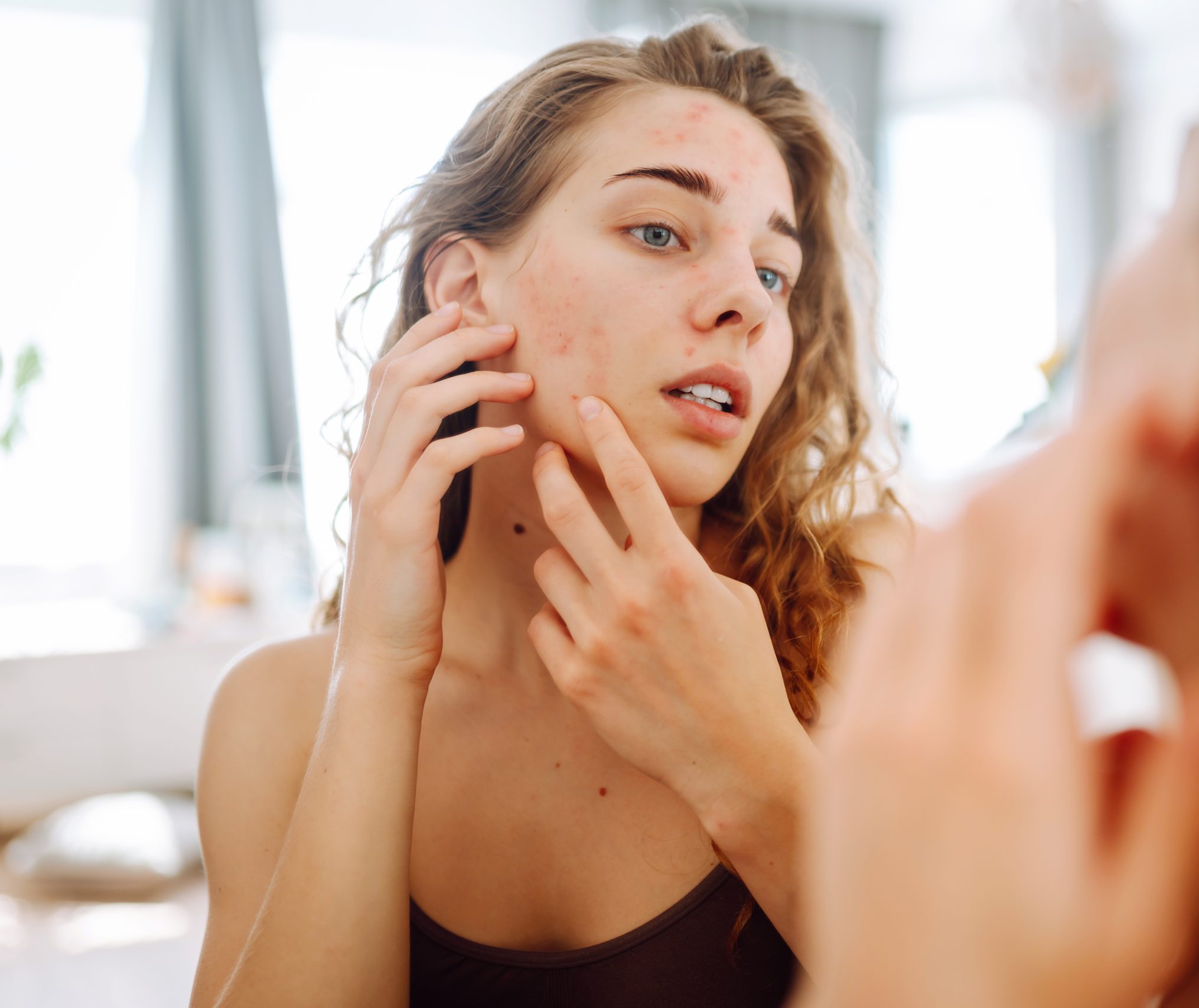 Woman examining acne and red spots on her face in a bathroom mirror