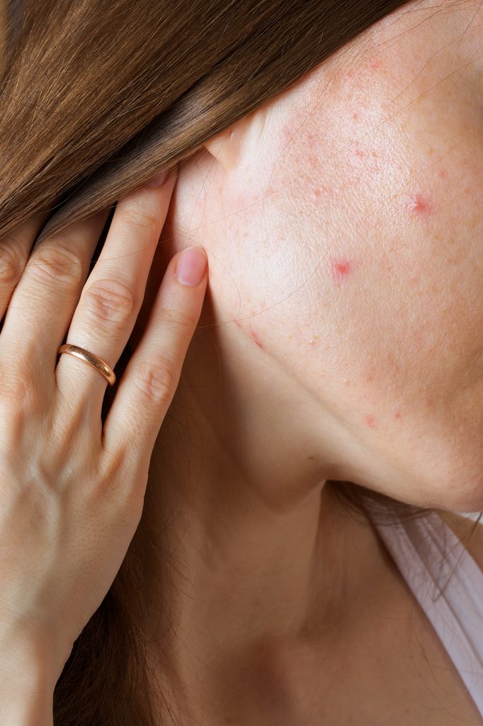 Woman's face showing red bumps and inflamed skin lesions on cheek and jawline