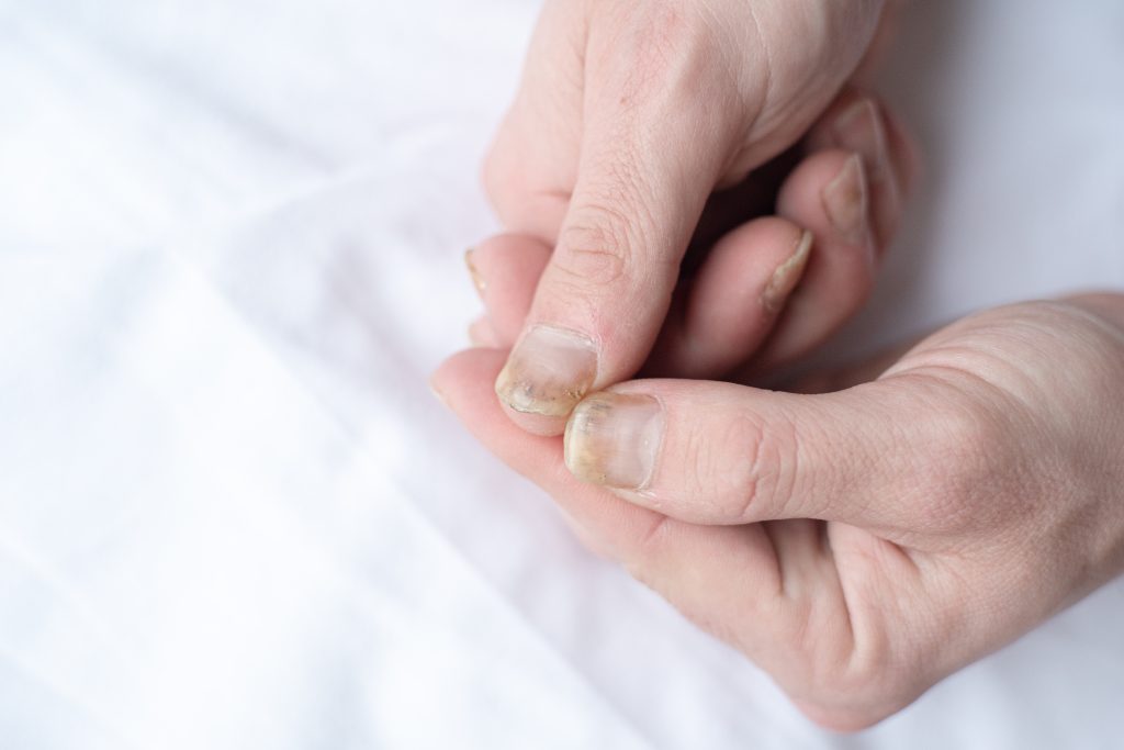 Close-up of fingernails showing discoloration and thickening from fungal infection