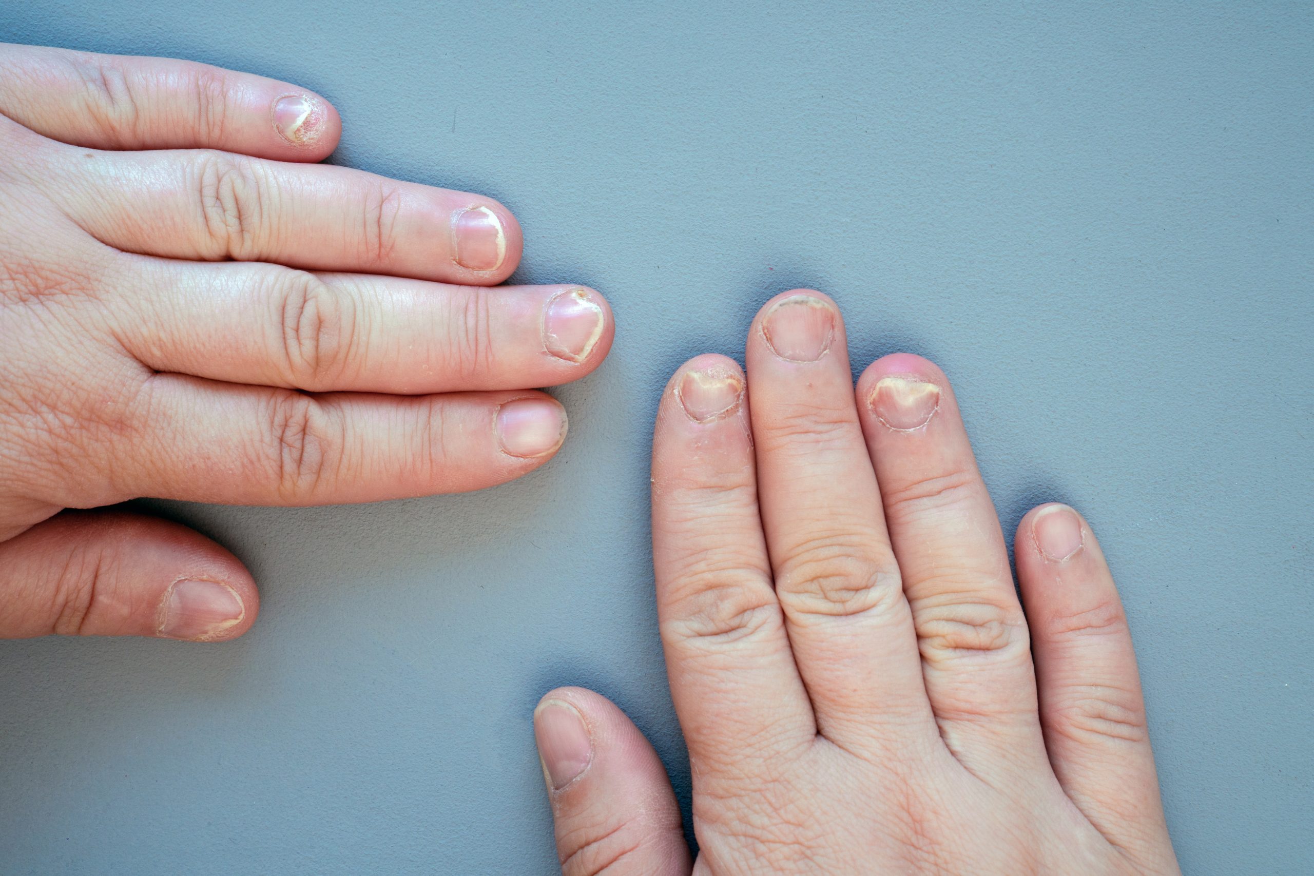 Close-up of fingernails showing onychomycosis with discoloration and separation from nail bed