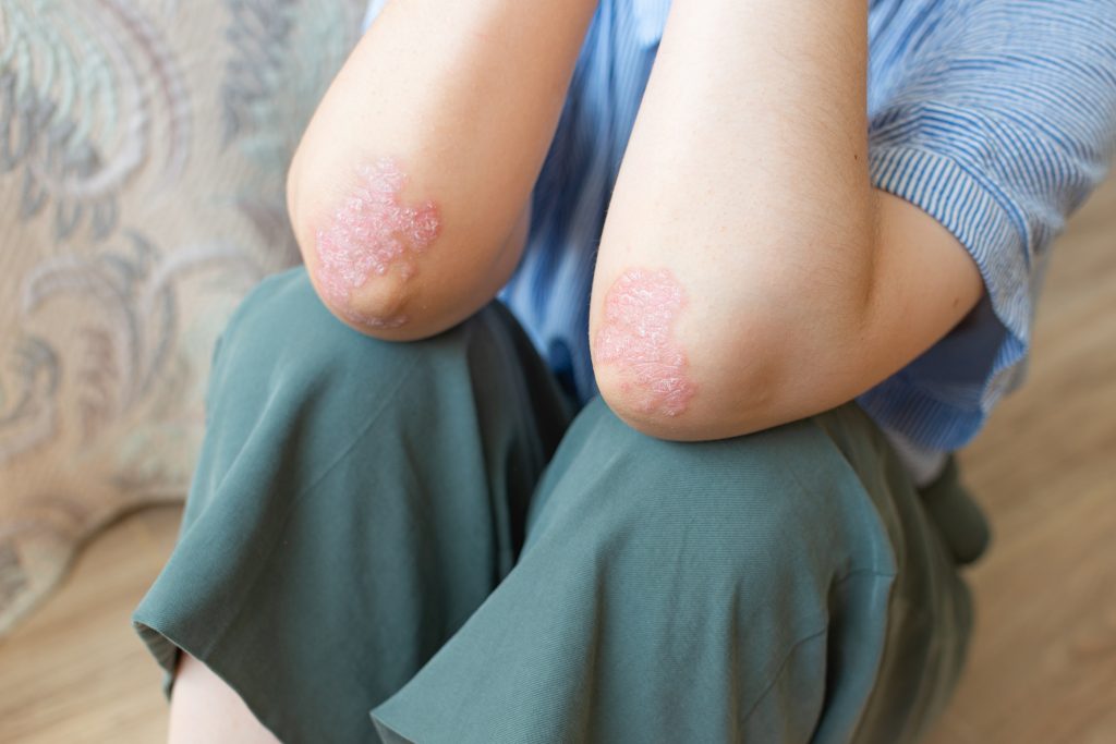 Woman sitting on bedroom floor showing psoriatic patches on both elbows