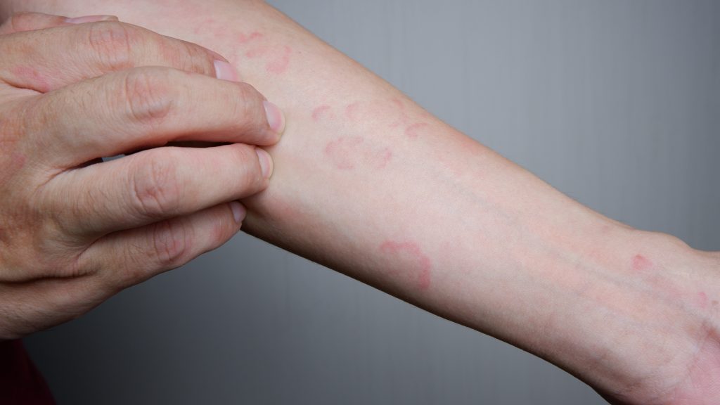 Arm with red raised welts and blotches characteristic of urticaria or hives