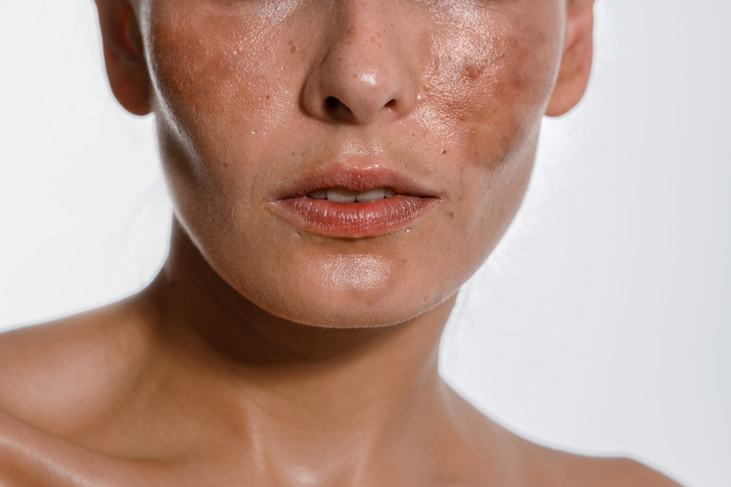 Close-up of female facial skin showing hyperpigmentation and uneven skin tone