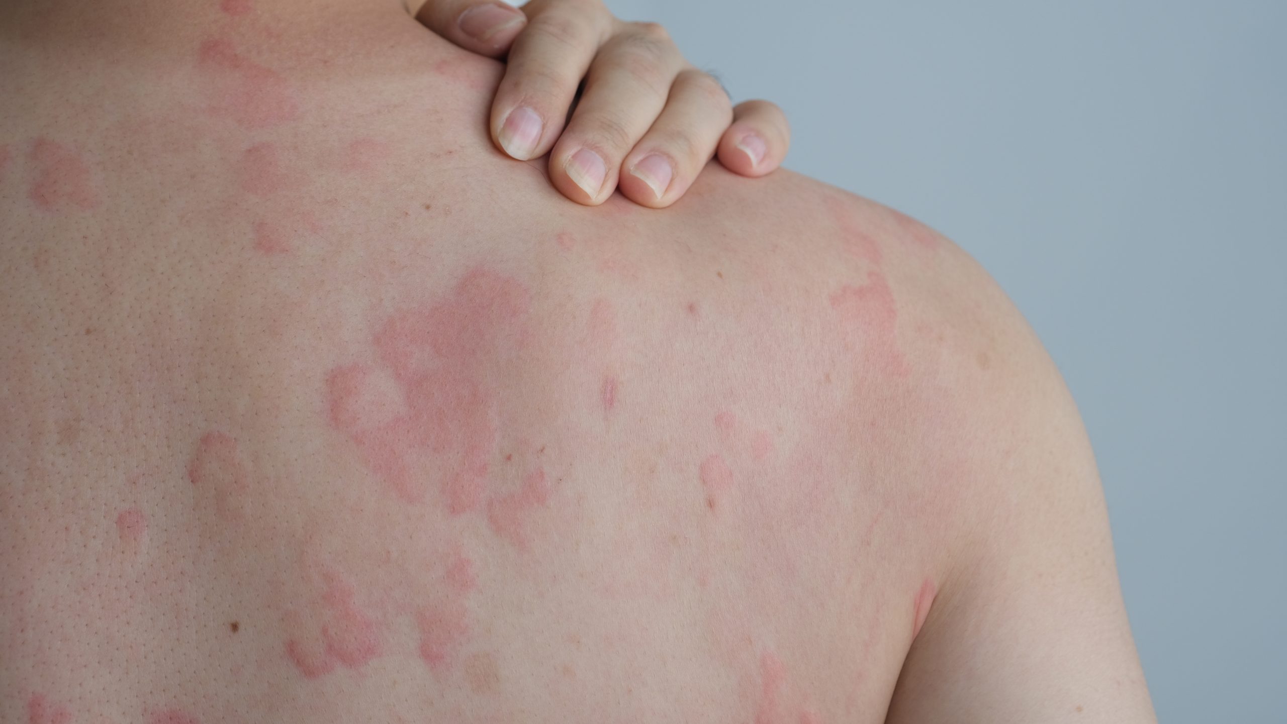 Close-up of skin with red, raised welts and blotches characteristic of urticaria or hives