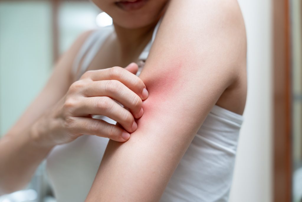 Woman scratching red, irritated patch on her arm showing signs of dermatitis or allergic reaction