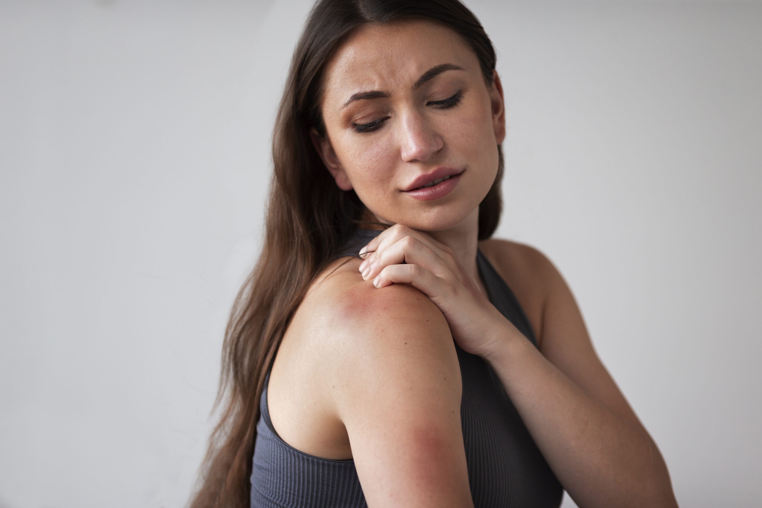 Woman with rash and irritation on her shoulder, scratching the affected area